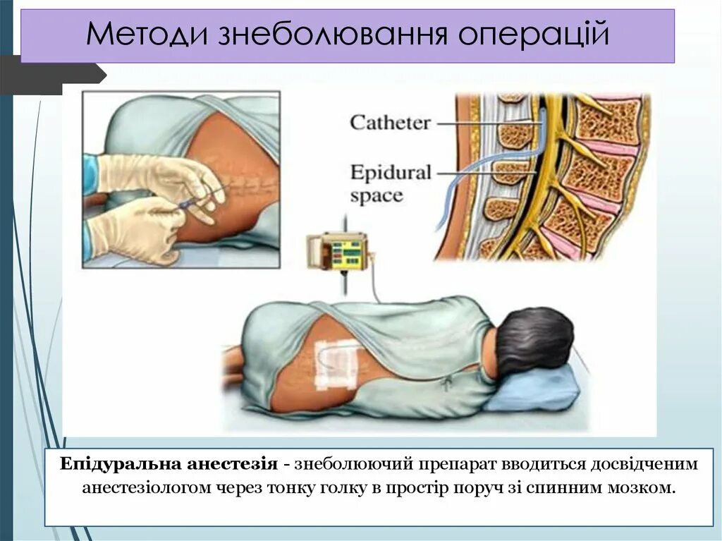 Проведение эпидуральной анестезии. Спинальная и эпидуральная анестезия. анестезии эндолюмбальная. спинальная анестезия при кесаревом. эпидуральная и спинномозговая анестезия.