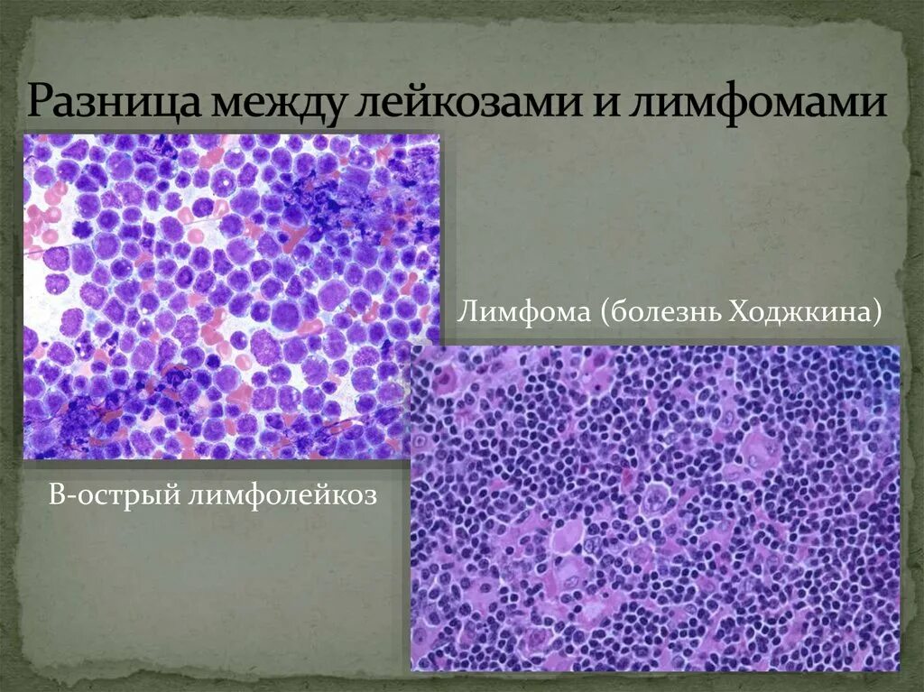 Лимфогранулематоз симптомы. Лимфогранулематоз клинические рекомендации. Неходжкинская лимфома патанатомия. Лимфогранулематоз исход болезни. Цитологическая картина лимфомы ходжкина.