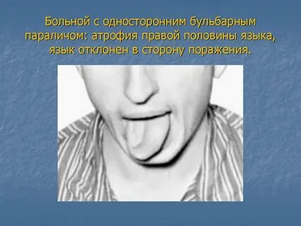 Язык при инсульте