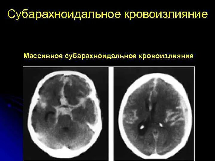 Субарахноидальное гематома. Субарахноидальное кровотечение на кт. Спонтанно кровоизлияние. Спонтанно кровоизлияние. Субарахноидальное кровоизлияние макропрепарат.