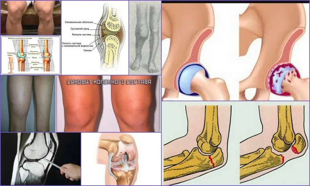 софья здоровые колени. воспалительный процесс колена. воспалительный процесс колена. бурсит воспаление суставной сумки. бурсит бурсит коленного сустава.