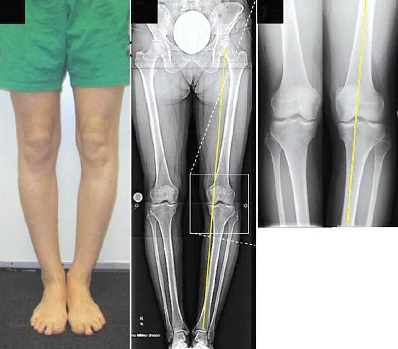 Вальгусная деформация коленных суставов рентген. Варусная деформация оси нижних конечностей. Вальгус коленных суставов рентген. Вальгус деформация коленных суставов.