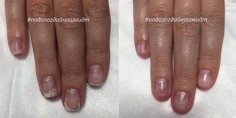 Можно ли онихолизис покрывать гель лаком ногтей