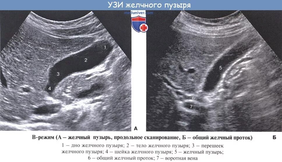 S образный желчный пузырь УЗИ. Изгиб желчного пузыря УЗИ. Загиб желчного пузыря на УЗИ. Перегиб желчного пузыря снимок УЗИ.