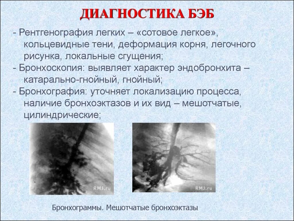 Бронхоэктатическая болезнь диагноз. Бронхоэктатическая болезнь (Бэб). Бронхоэктатическая болезнь бронхография. Бэб легких диагностика.