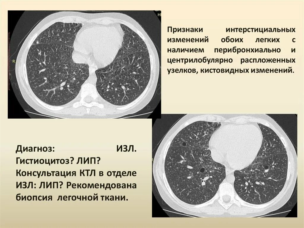 Интерстициальная пневмония на кт. Интерстециальные заболевания лёгких кт. Интерстициальные заболевания лёгких кт. Интерстициальные болезни легких кт. Интерстициальные изменения в легких что это