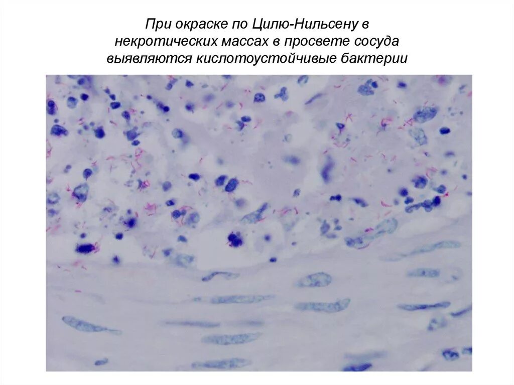 Туберкулез циль нильсену. Окрашивание по Цилю-Нильсену. Окраска кислотоустойчивых микобактерий по Цилю-Нильсену. Микроскопия по Цилю Нильсену туберкулез. Окраска мокроты по Цилю-Нильсену.