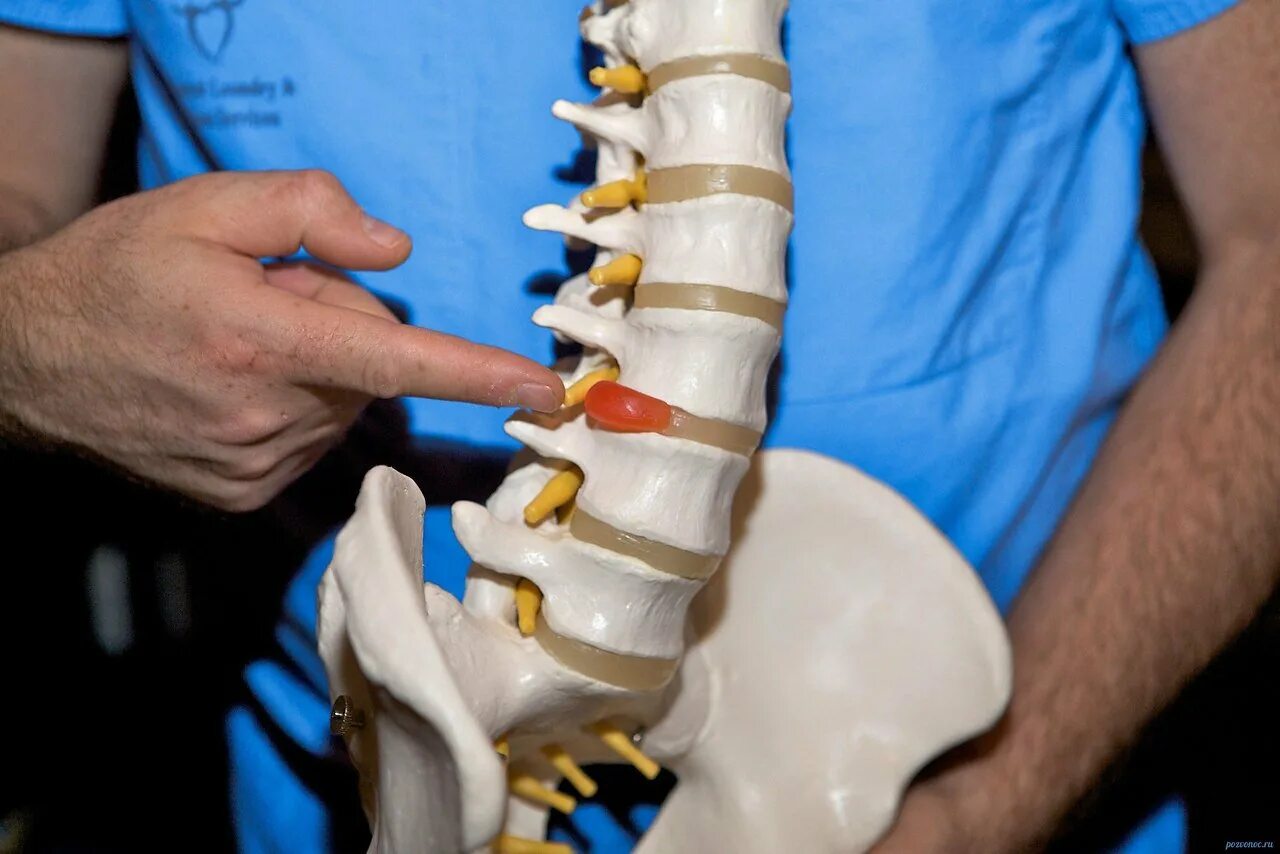 Грыжа поясничного отдела лечение у мужчин симптомы. Грыжа диска. Междисковая грыжа позвоночника. Грыжи и протрузии позвоночника. Грыжа межпозвонковых дисков.