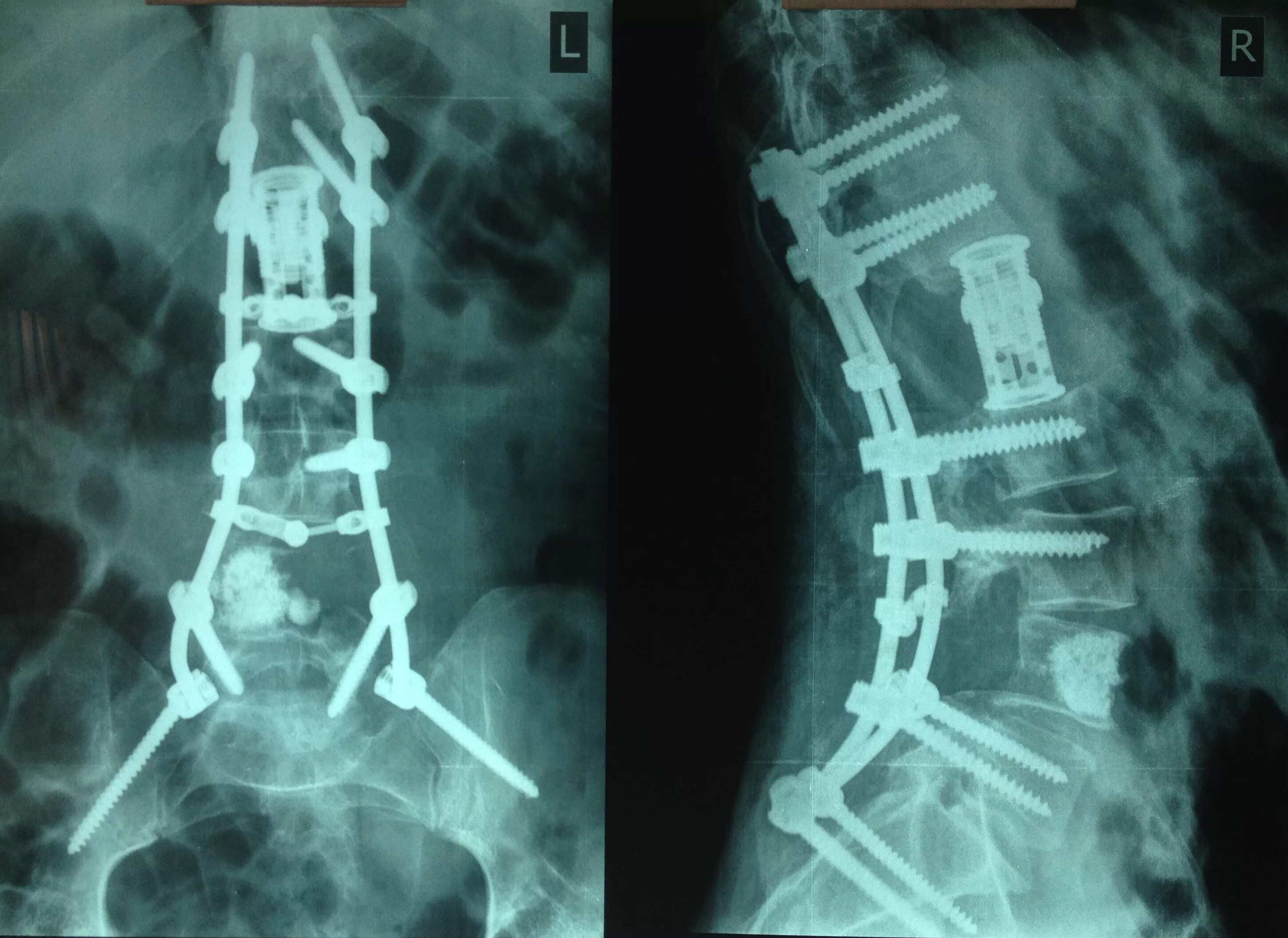 Операция фиксация позвоночника. Транспедикулярная фиксация l4 l5 s1. Спондилодез поясничного отдела позвоночника рентген. Транспедикулярная фиксация th11 th12- l2 l3. Вертебропластика s1 позвонка.
