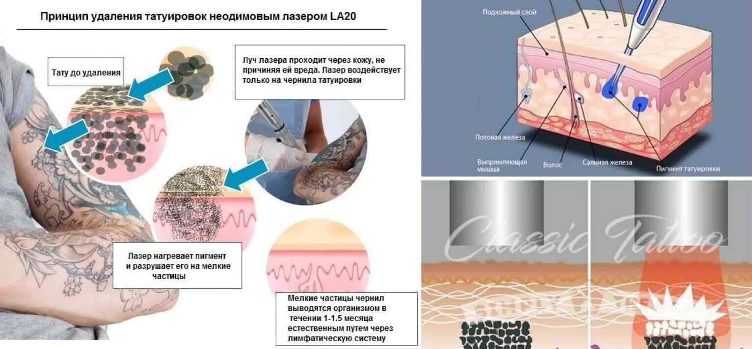 Лазерная эпиляция можно ли заразиться