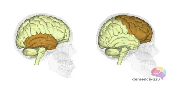 Лобно височное поражение. Лобно-височная деменция. Деменция лобно-височной доли. Теменно височная деменция. Болезнь лобно височная деменция.