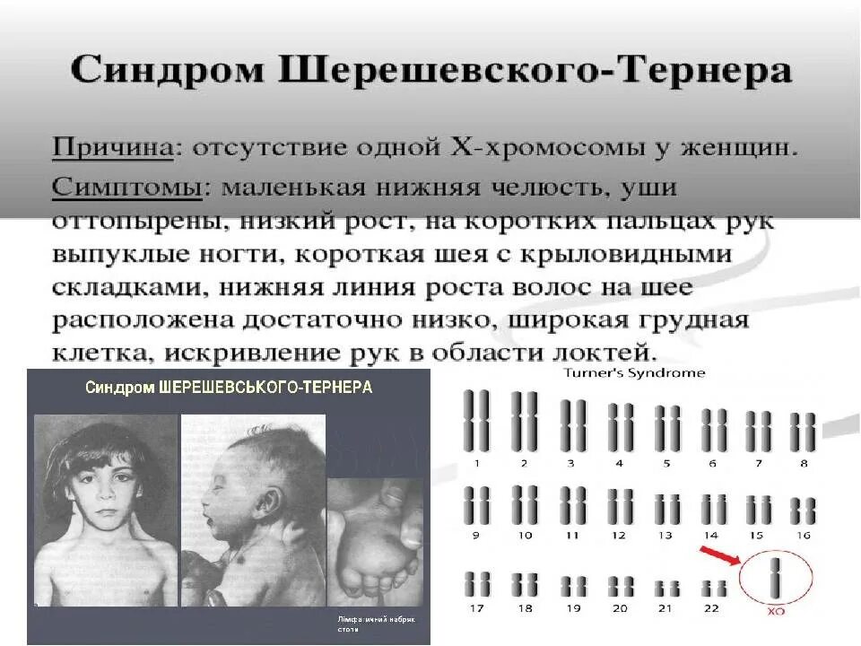 Синдром дауна генотип и фенотип
