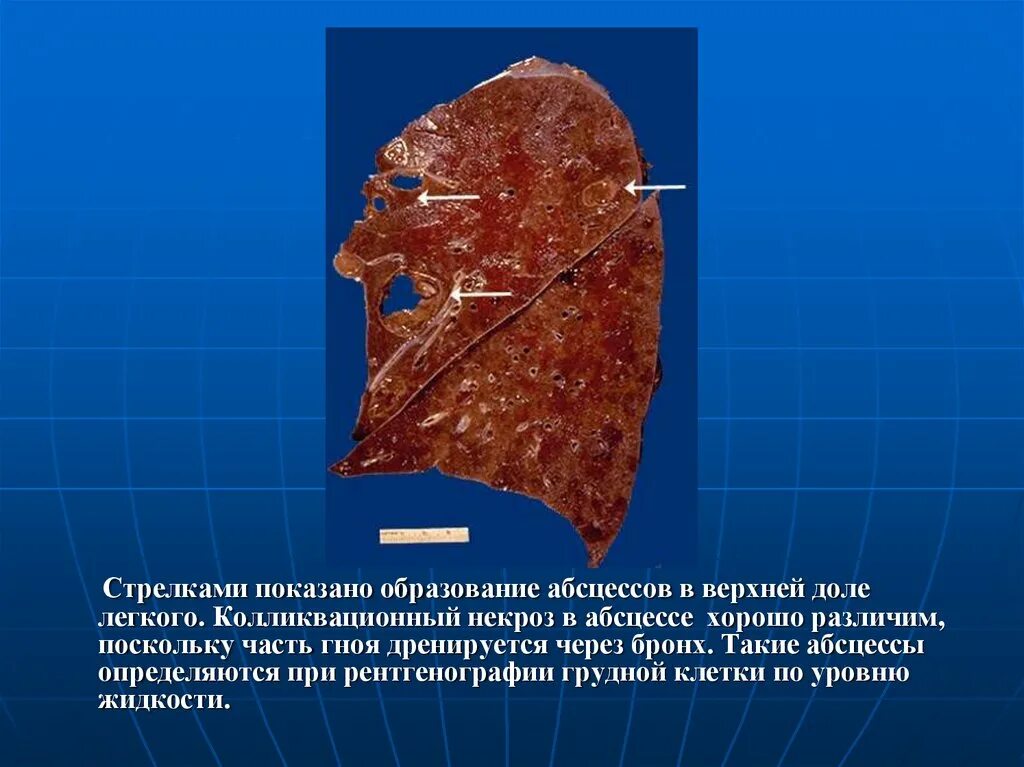 Колликвационный некроз это. Колликвационный некроз макропрепарат. колликвационный (влажный) некроз. колгиаутсионный некроз. квалюкационный некроз.