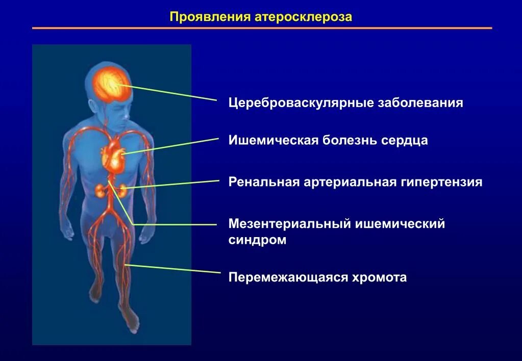 Атеросклероз церебральных сосудов симптомы. Цереброваскулярные заболевания. Болезнь цереброваскулярная атеросклеротическая. Цереброваскулярный атеросклероз. Церебральный атеросклероз симптомы.