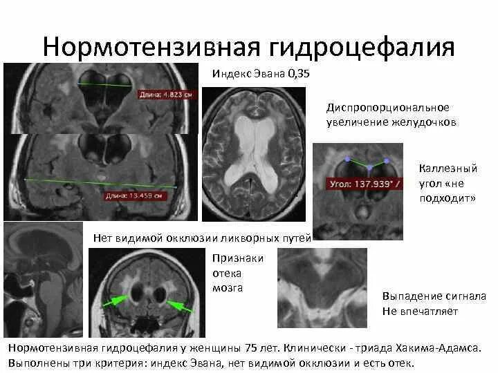 Норма желудочков мозга у взрослых. Нормотензивная гидроцефалия головного мозга мрт. Гидроцефалия боковых желудочков головного мозга. Нормотензивная гидроцефалия мрт критерии. Нормотензивная гидроцефалия КАЛЛЕЗНЫЙ угол.