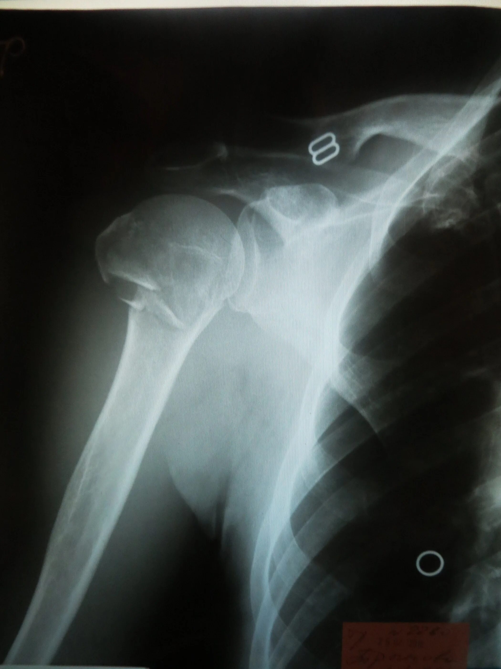 Вколоченный перелом шейки плеча рентген. Вколоченный перелом шейки плечевой кости рентген. Вколоченный перелом плечевой кости рентген. Вколоченный перелом шейки плеча рентген снимки. Перелом плеча пластина