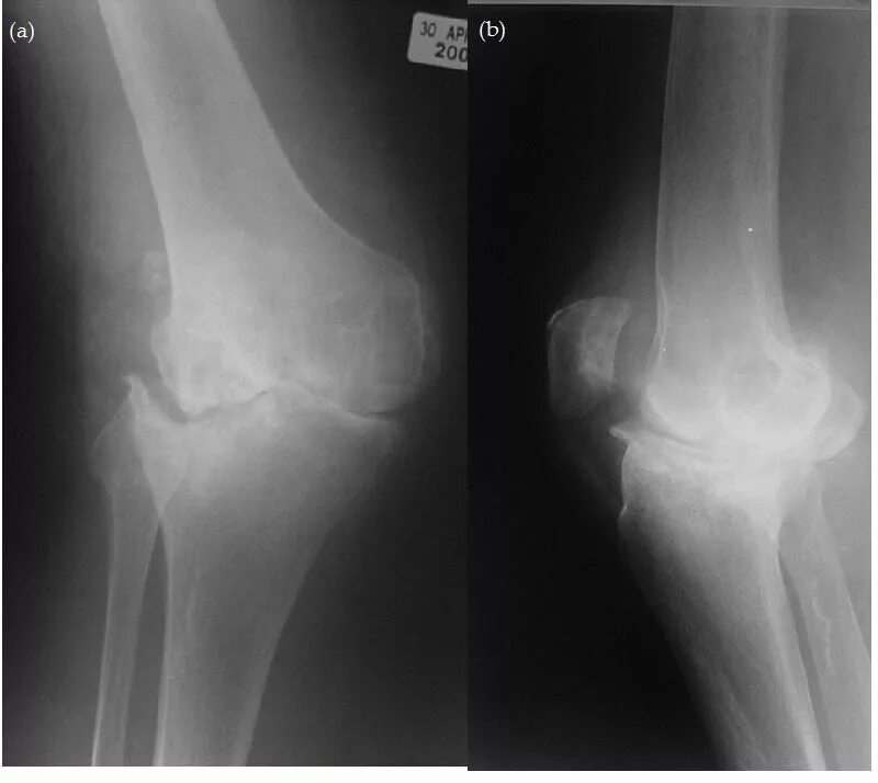 Артрит коленного сустава в домашних условиях. Ревматоидный артрит рентген колени. Ревматоидный артрит коленного сустава рентген. Ювенильный ревматоидный артрит коленных суставов на рентгене. Ревматоидный артрит деформация коленных суставов.