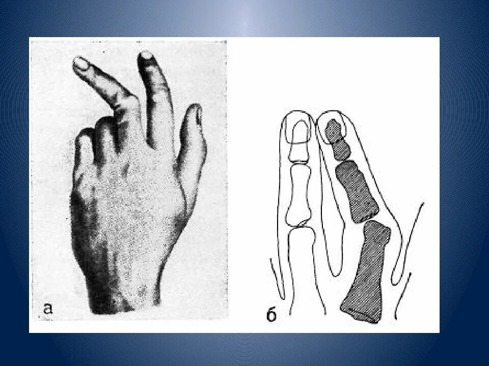 Как лечить фаланги пальцев. Подвывих проксимальной фаланги 1 пальца. переломы и вывихи пястных костей и фаланг пальцев кисти. межфаланговые суставы кисти вывих. подвывих ногтевой фаланги.