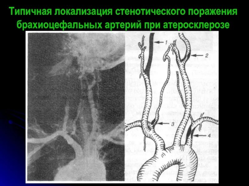 Стенозирующий атеросклероз бца что это такое простыми. Брахиоцефальных артерий. брахиоцефальные артерии. атеросклероз брахеиоцефальныхартерий. атеросклеротическое поражение артерий брахиоцефального сегмента.