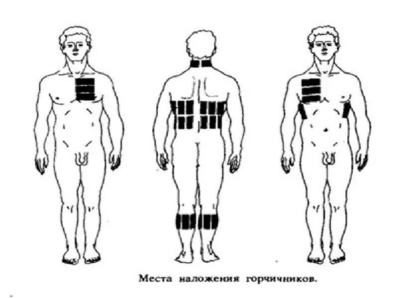 Места постановки горчичников схема. Горчичники схема наложения. Места постановки горчичников при гипертоническом кризе. Места постановки горчичников при кашле. При бронхите можно ставить горчичники взрослым