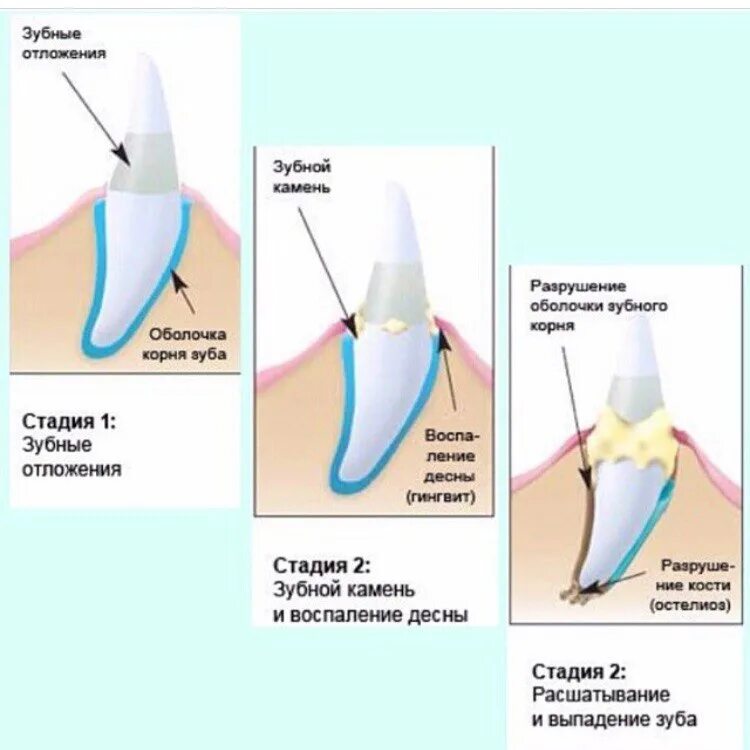 Обнажаются корни зубов.