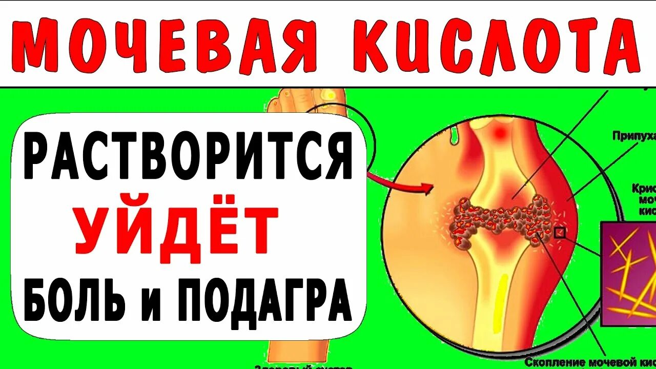 Мочевая кислота выводится из организма. Выгнать мочевую кислоту из организма. Подагра диета. Выводить мочевую кислоту..