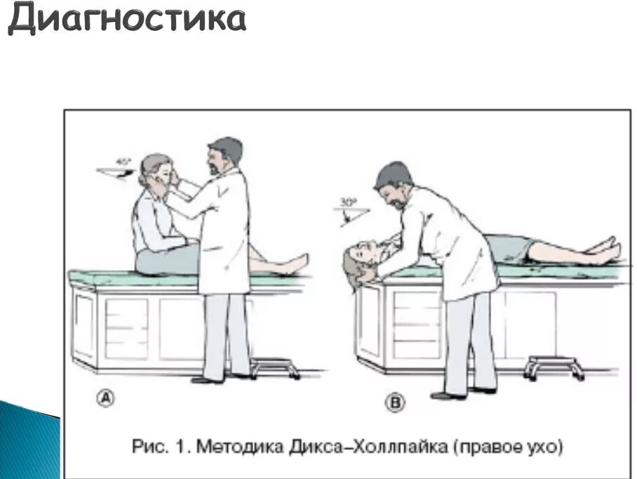 Проба холпайка. Проба Дикса-Холпайка. Позиционная проба Дикса Холпайка. Проба Дикса Холпайка при ДППГ. ДППГ тест Дикса Холлпайка.