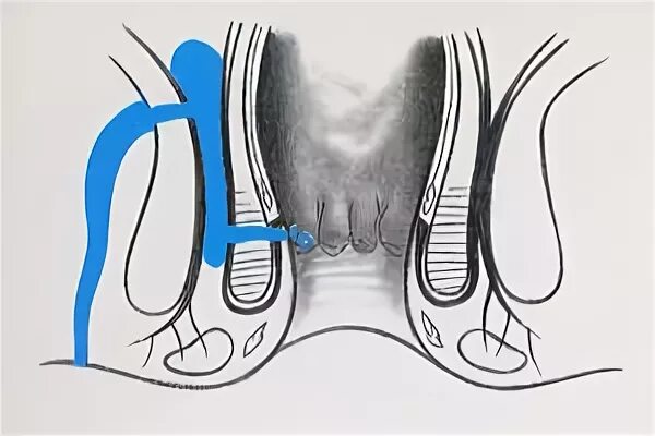 Параректальный свищ ход операции. Свищ прямой кишки отзывы после операции. Свищ прямой кишки отзывы после операции. Рассечение свища в просвет прямой кишки операция габриэля. Свищ прямой кишки операция.
