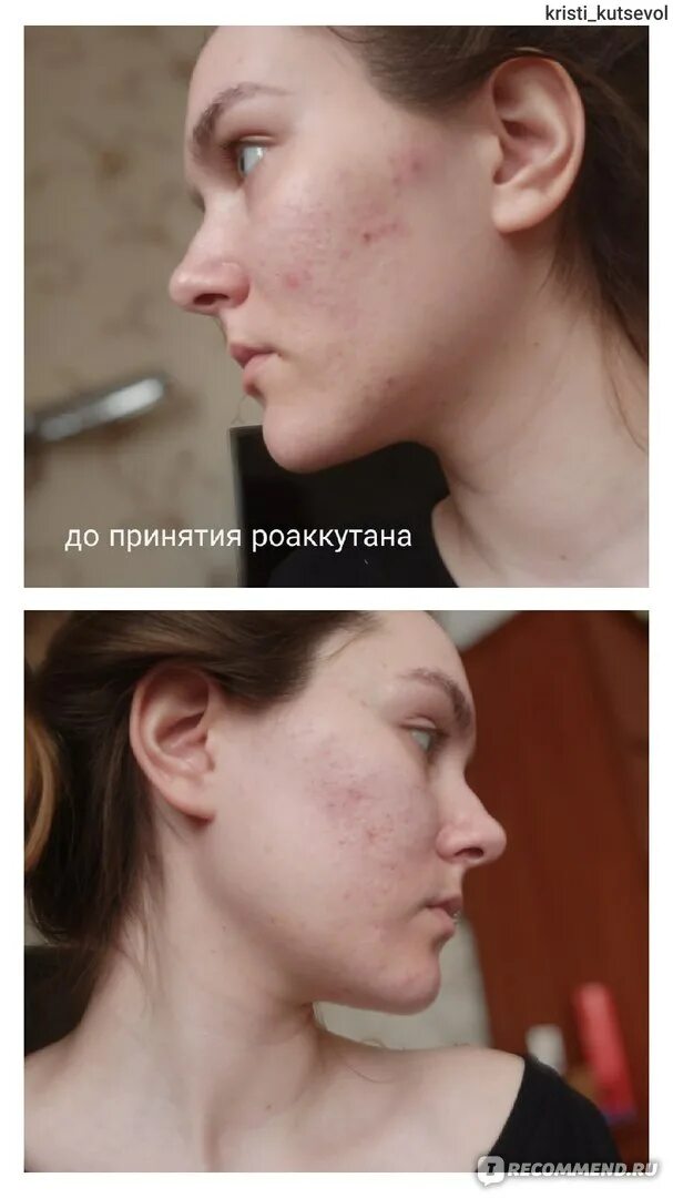 Роаккутан до и после отзывы Роаккутан до и после