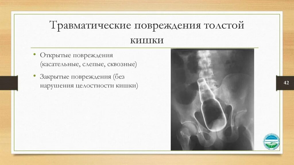 Повреждение толстой кишки. Повреждение тонкой кишки. Ранение тонкой кишки классификация.