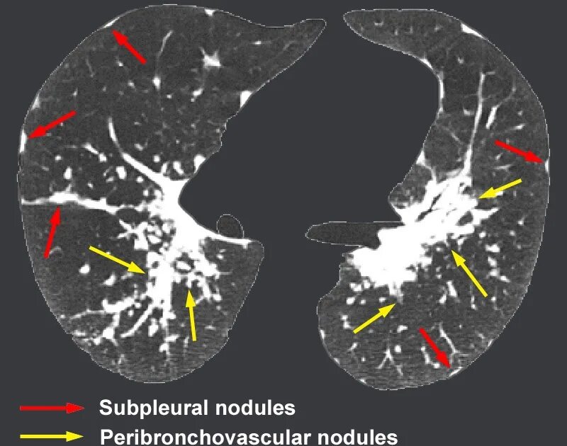 Дерева в почках в легких кт. Перилимфатические очаги кт. Перилимфатический очаг. Перибронховаскулярные очаги. Перилимфатическая диссеминация легких кт.