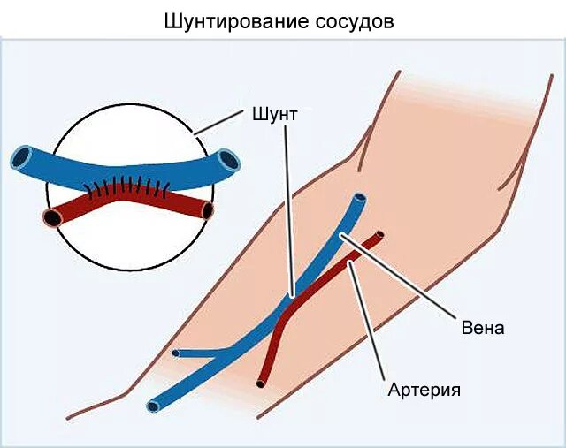 Поставили шунты