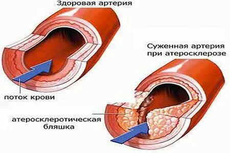 Атеросклероз глаза