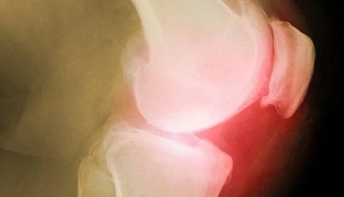 Болезнь соли в суставах. Отложение солей в суставах. солевые отложения в суставах. отложение солей в коленном суставе.
