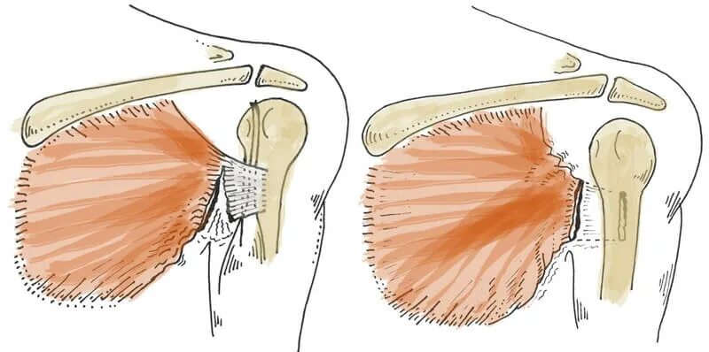 Лечение частичного разрыва мышц. Отрыв сухожилия грудной мышцы. Надрыв большой грудной мышцы. Разрыв сухожилия грудной мышцы. Разрыв сухожилия большой грудной мышцы.