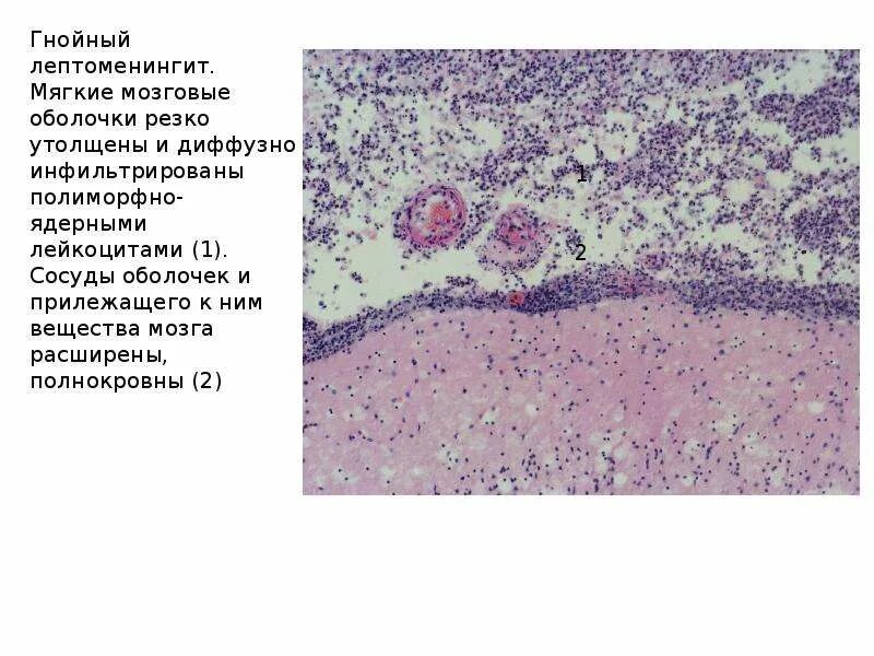 Гнойный менингит препарат патанатомия. Гнойный менингит микропрепарат. Гнойный менингит макропрепарат. Гнойный менингит микроскопическая картина.