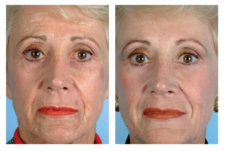 PMD Personal Microderm Results Personal microderm, Microderm, Pmd personal micro