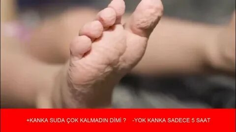 Wrinkled foot
