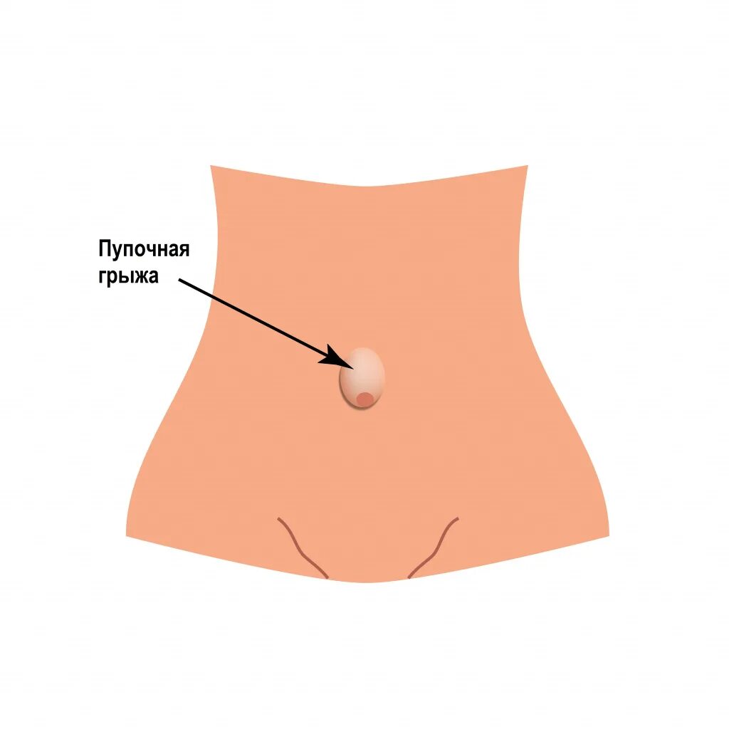 Эпигастральная грыжа белой линии живота. Гипогастральная грыжа. Пупочная грыжа симптомы. Боли в животе в паховой области