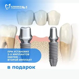 При установке 2-х имплантов OSSTEM по цене 22 000, второй имплант в подарок...