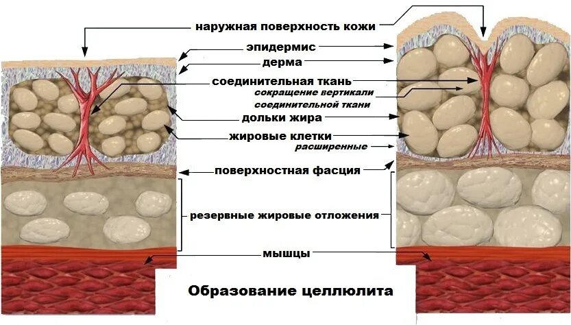 Плотный появление. Целлюлит строение жировой ткани. Строение кожи целлюлит. Целлюлит жировые клетки. Подкожно-жировая клетчатка целлюлит.