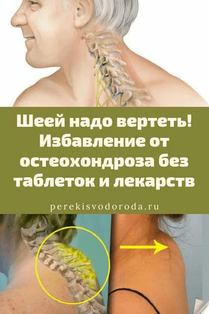 Как убрать шейный остеохондроз. Шейный остеохондроз. остеохондроз шейного отдела. при остеохондрозе шейного отдела.