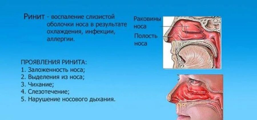 Почему лежа закладывает нос. Насморк и заложенность носа. воспаление слизистой оболочки носовой полости.