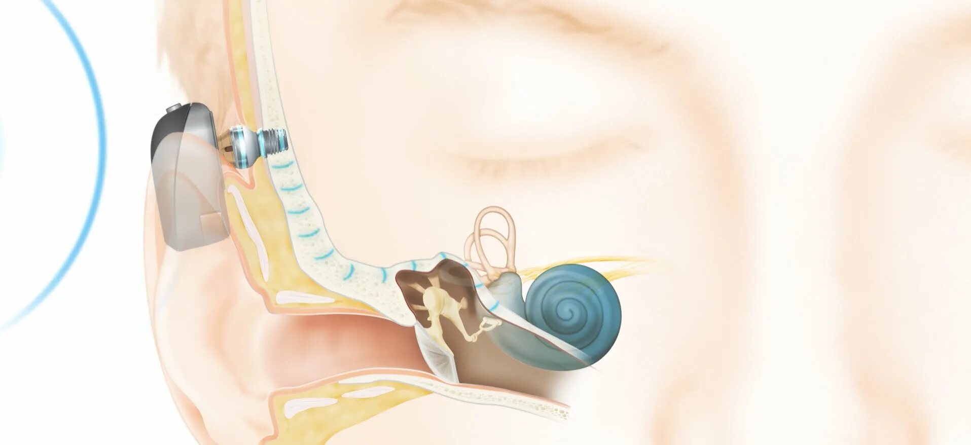 Неимплантируемый слуховой аппарат Baha. Ponto слуховой аппарат костной проводимости неимплантируемый. Имплант костной проводимости. Баха аппарат костной проводимости. Операция на ухо на слух