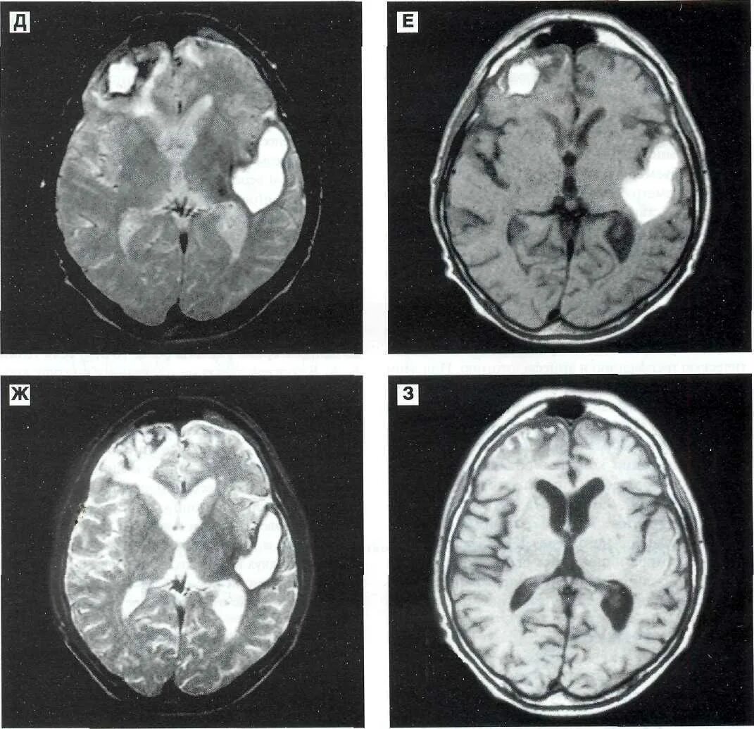 Травма мозга очаговая. Черепно мозговая травма мрт. Внутримозговая гематома мрт. Внутримозговая гематома правой лобной доли.