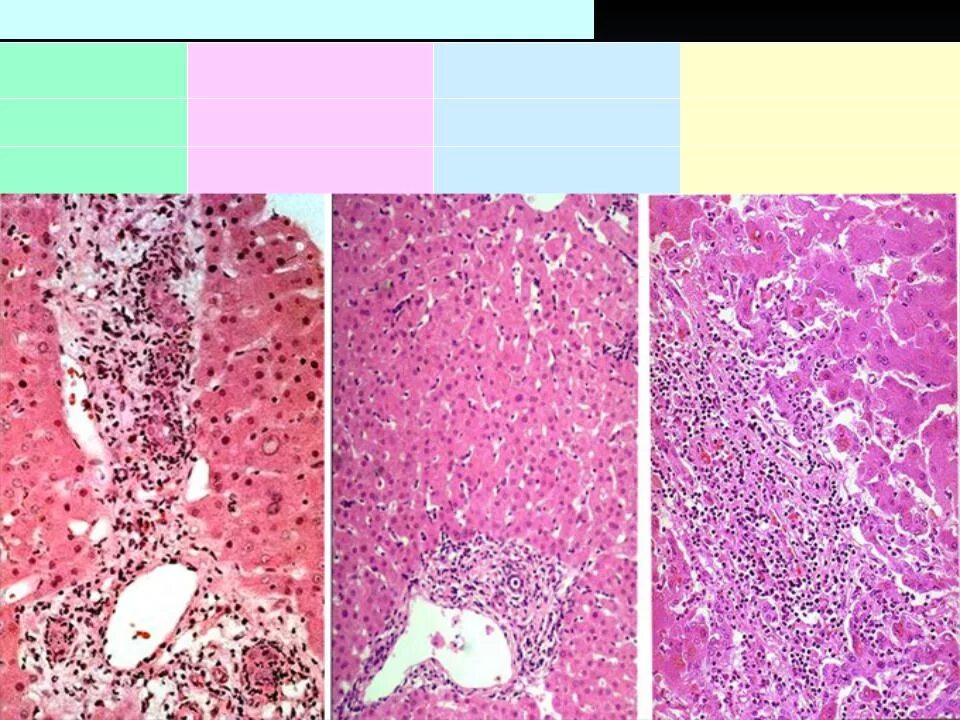 Холестатическая форма вирусного гепатита. Хронический гепатит патанатомия. Холестатический гепатит гистология. Хронический вирусный гепатит макропрепарат.
