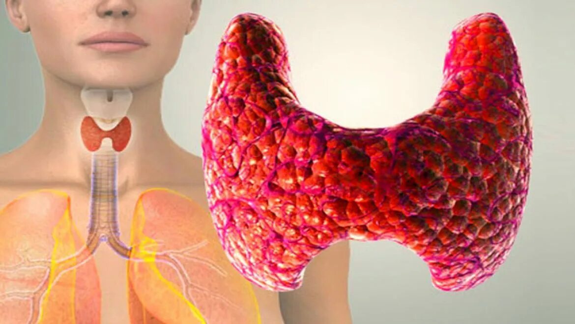 Лечение эутиреоза щитовидной железы у женщин. Тиреоидит Риделя макропрепарат. АИТ зоб щитовидной железы. Щитовидная железа бабочка.
