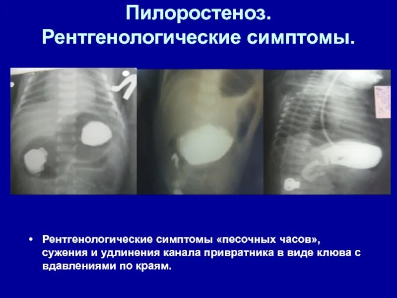 Врожденный гипертрофический пилоростеноз. Пилоростеноз рентген у новорожденного. Врожденный гипертрофический пилоростеноз патогенез. Симптомы врожденного пилоростеноза. Симптомы песочные часы