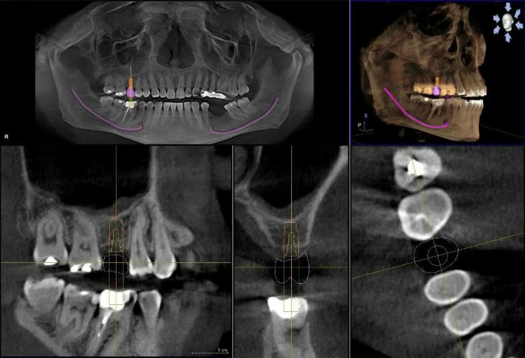 Имплант и мрт можно ли. Компьютерная томография челюстей VATECH. Аппарат для 3д рентгена челюсти.