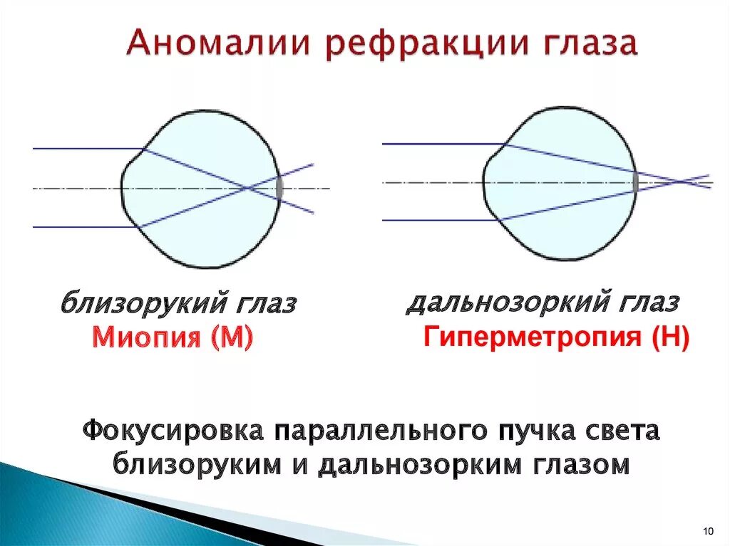 Аномалии рефракции глаза их коррекция. Аномалии рефракции глаза схема. Аномалии рефракции глаза анатомия. Аномалии рефракции таблица близорукость дальнозоркость. Какое зрение при дальнозоркости